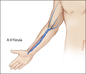 Figure of Arteriovenous Fistula