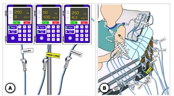 Figure 3. Labeling Multiple IV Infusions 