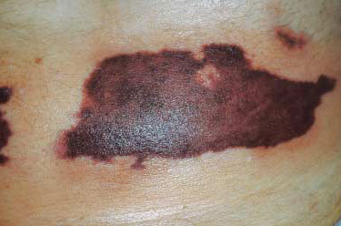 Figure 2. Heparin-Induced Skin Necrosis. (Picture reprinted with permission from International Journal of Dermatology.)