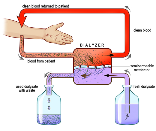 Figure of The hemodialysis process