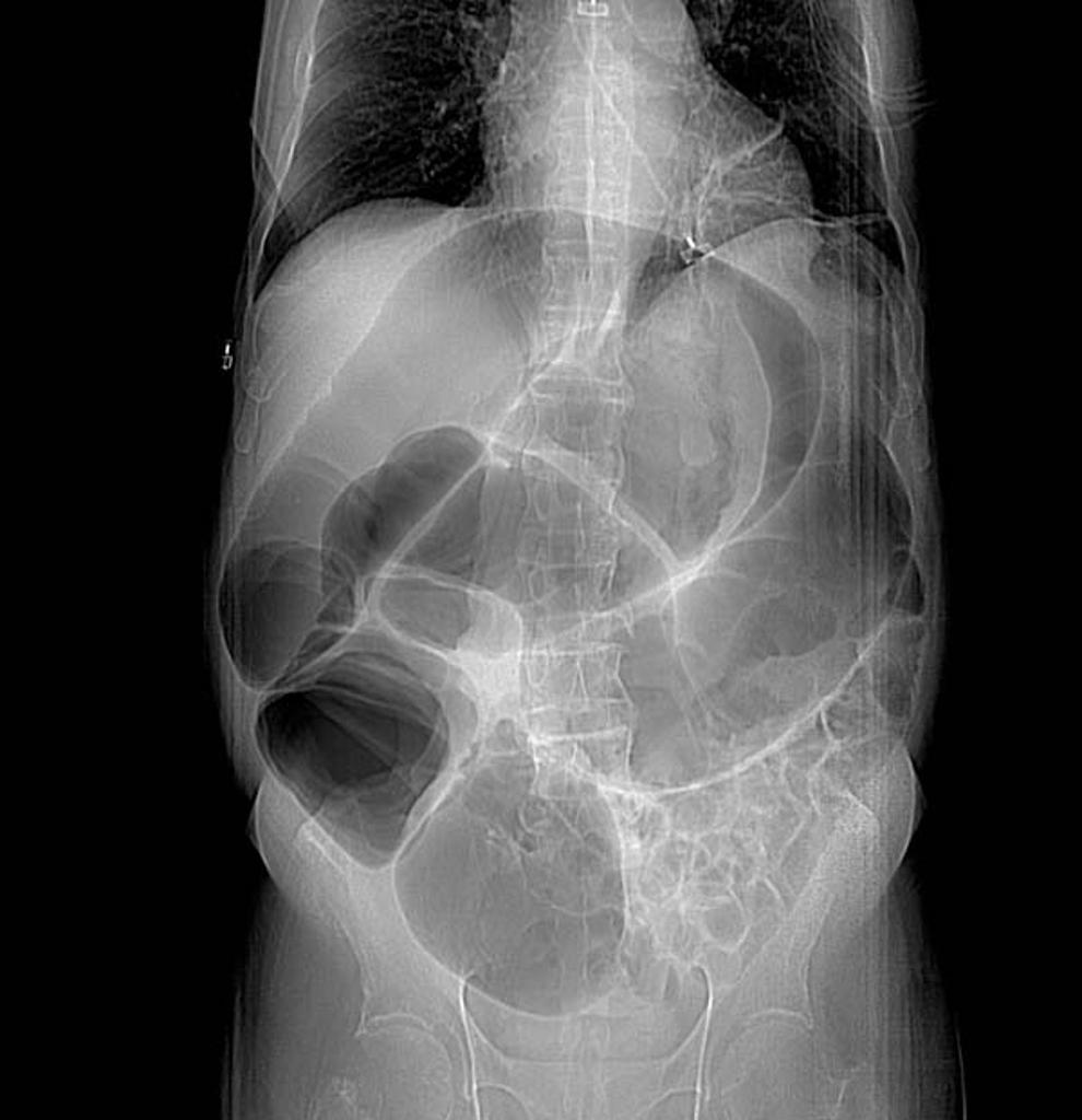 Figure of Radiograph of Acute Colonic Pseudo-obstruction.