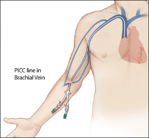 Figure of Peripherally Inserted Central Catheter in Brachial Vein